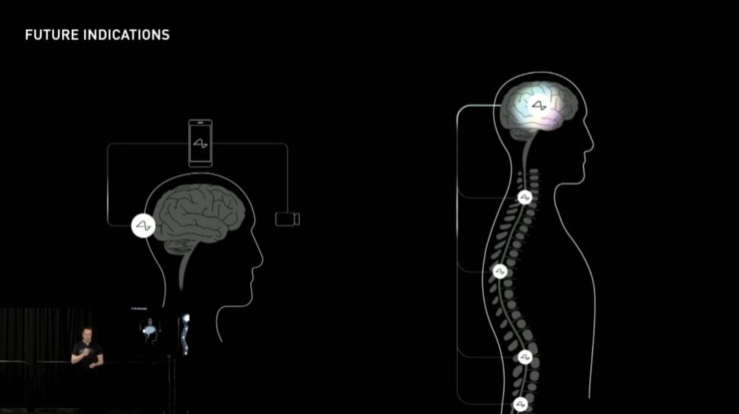 马斯克提及Neuralink未来计划：2025年将为部分患者提供脑机接口植入_马斯克脑植入芯片_马斯克发明植入脑机接口
